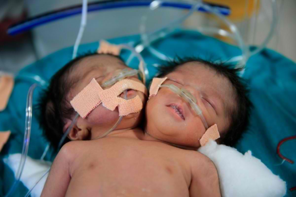 В Индии родилась девочка с двумя головами